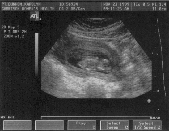 11 week ultrasound pic!